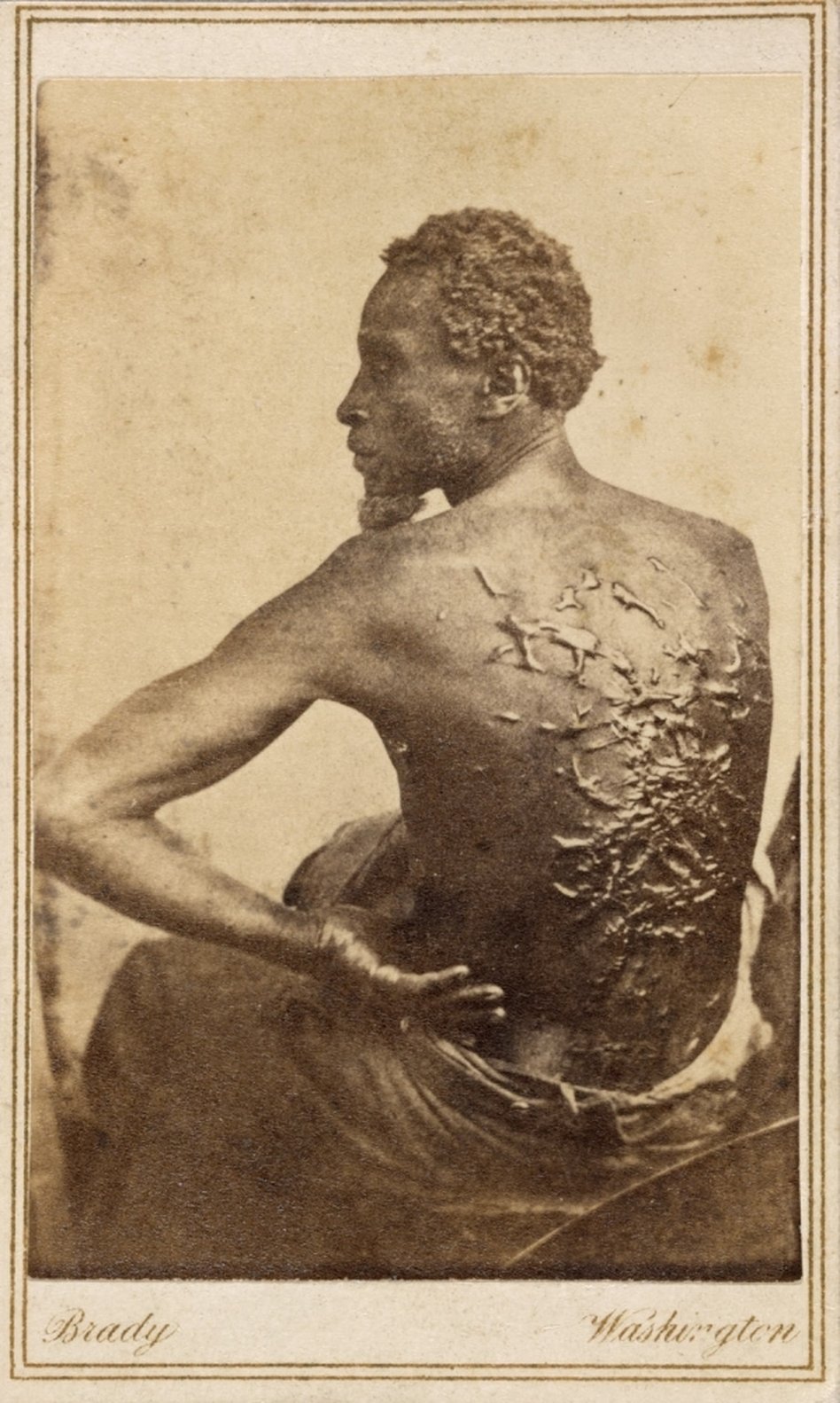 The Scourged Back — 1863 photograph of an enslaved man named Gordon (also called Whipped Peter), showing whipping scars.